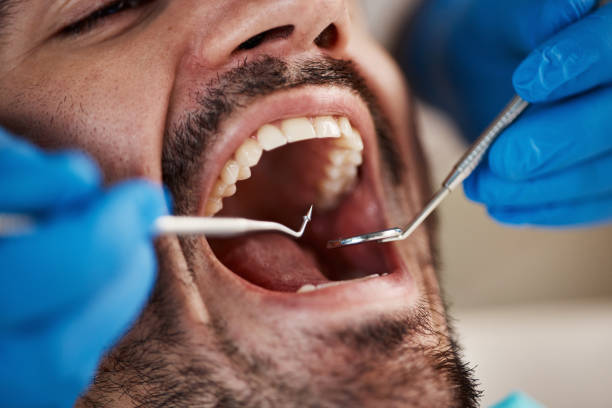 Best Knocked-Out Tooth (Avulsed Tooth) Treatment in Clyde, NY